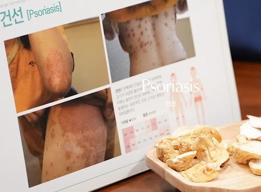 생기한의원으로 알아보는 건선 한의원 상담 전 준비 사항